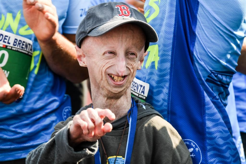 Sammy, the boy who made Progeria Syndrome known worldwide